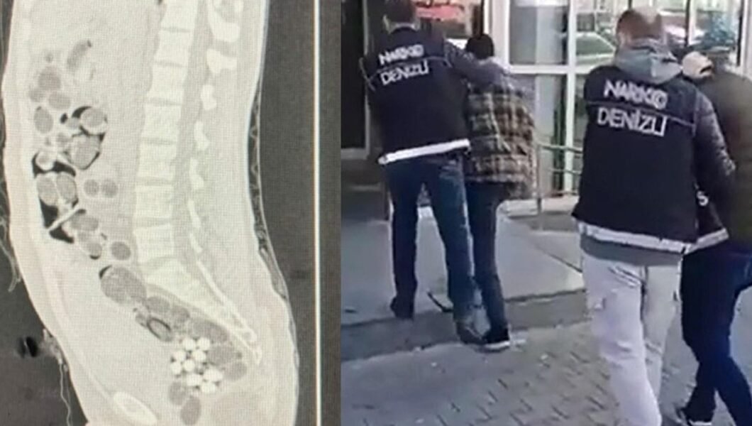 Yolcunun midesinden 219 paket uyuşturucu çıktı